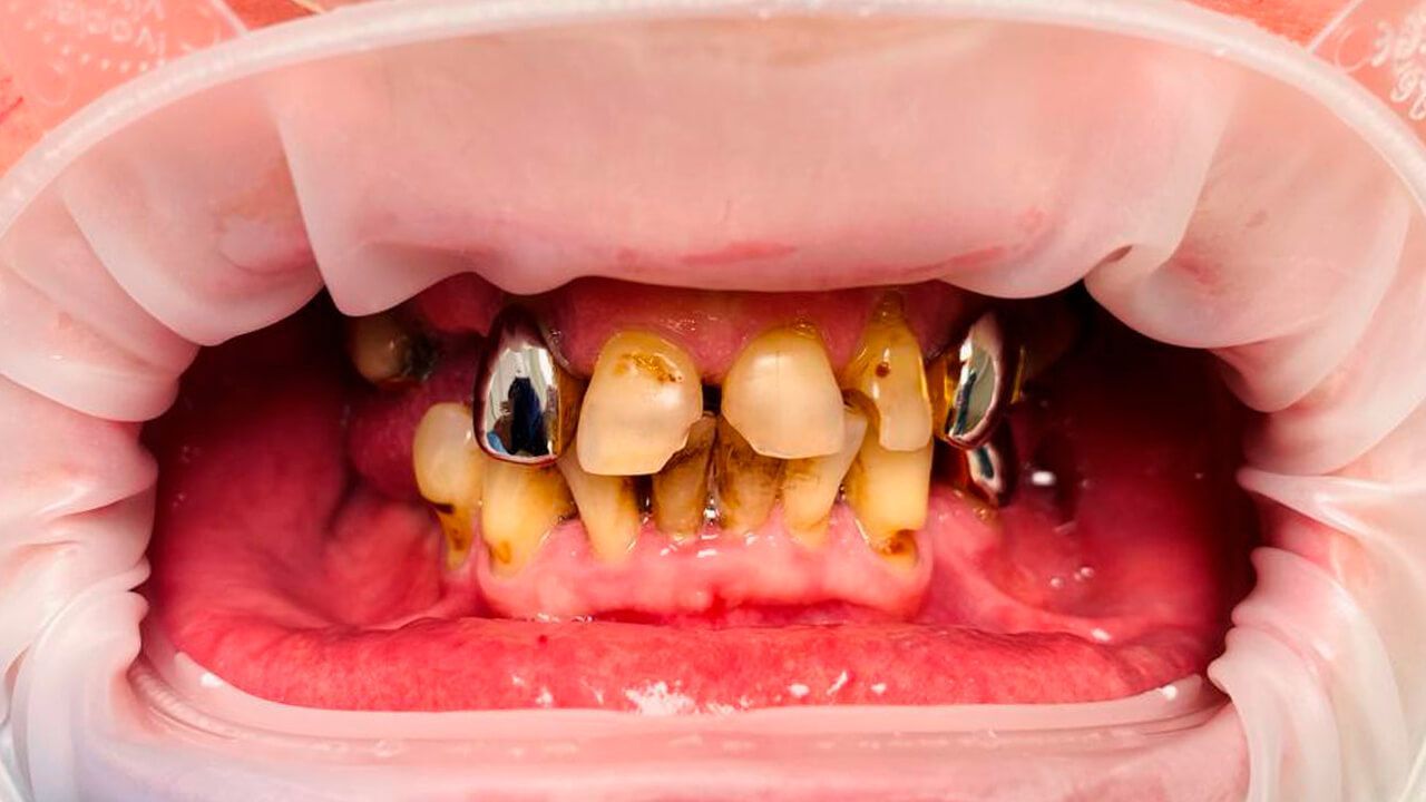 Отсутствие и подвижность зубов верхней и нижней челюстей